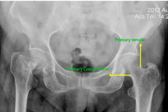 Gambar  4.2  Ilustrasi  kasus  fraktur  collum  femur  dengan  modified  Singh  index  grade B 