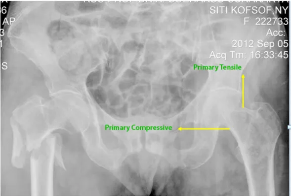 Gambar 4.4 Ilustrasi kasus fraktur intertrochanter femur dengan modified Singh  index grade B 