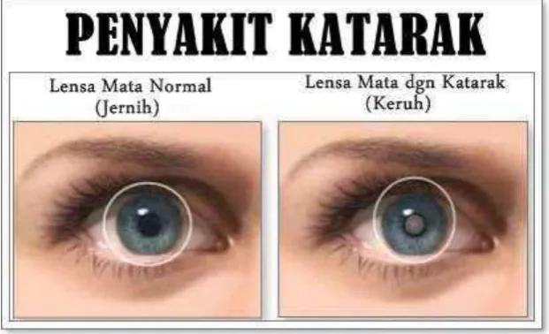 Gambar 2.2 Mata Katarak 