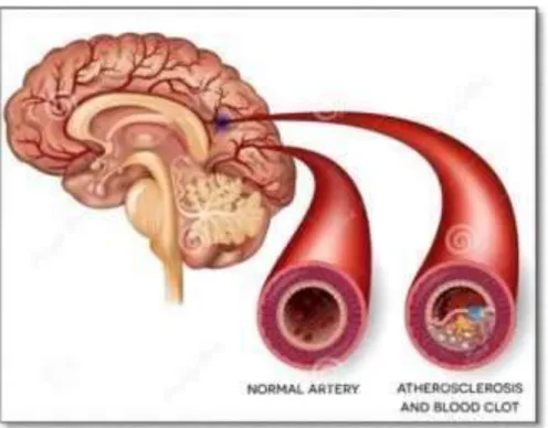 Gambar 1.2 Arteri serebral normal dan arteri dengan aterosklerosis  (Dreamstime, 2017) 