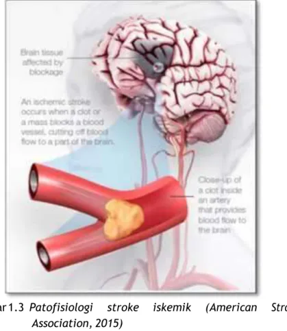Gambar 1.3  Patofisiologi  stroke  iskemik  (American  Stroke  Association, 2015) 
