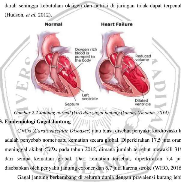 Gambar 2.2 Jantung normal (kiri) dan gagal jantung (kanan) (Anonim, 2014)  2.3. Epidemiologi Gagal Jantung 