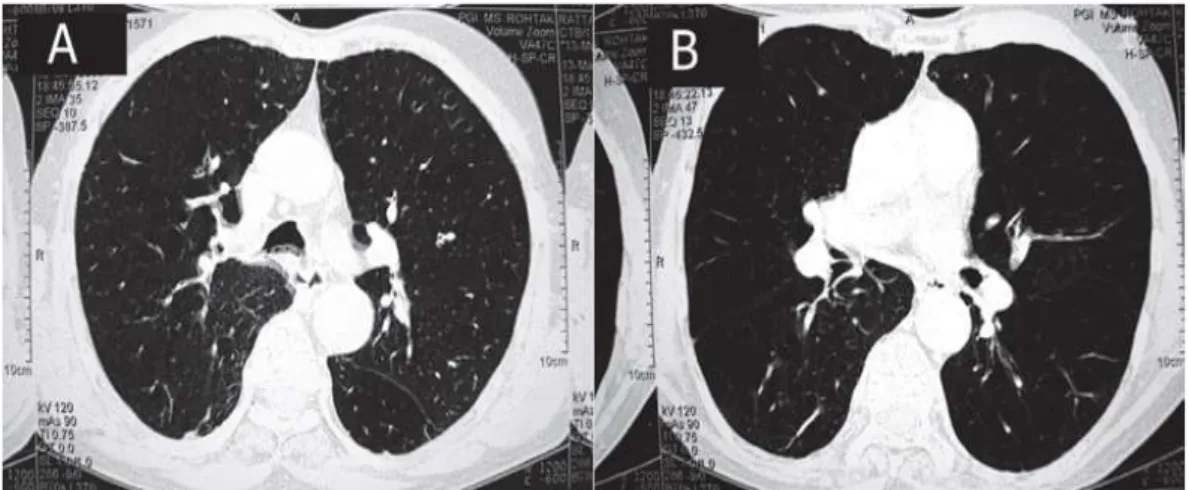Gambar barrel chest pada CT Scan. 10