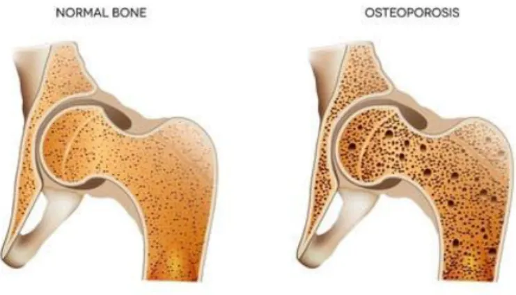 Gambar 2.2 Perbandingan Tulang Normal dan Osteoporosis [1] 