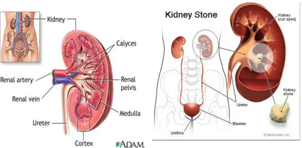 Gambar 2. Anatomi Ginjal Normal dan Ginjal dengan BSK  b.   Ureter 