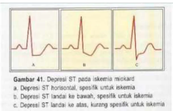 Gambar 2.3 Perubahan gelombang EKG  E. PENATALAKSANAAN INFARK MIOKARD 