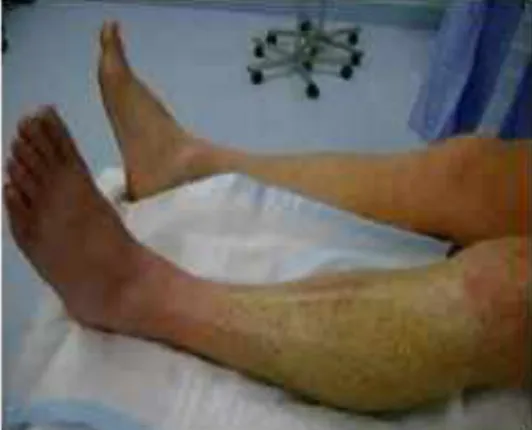 Gambar 3.3 Sindroma Kompartemen pada kaki kiri 