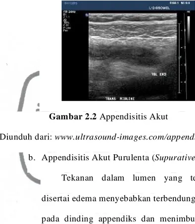 Gambar 2.2 Appendisitis Akut 