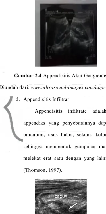 Gambar 2.4 Appendisitis Akut Gangrenosa 