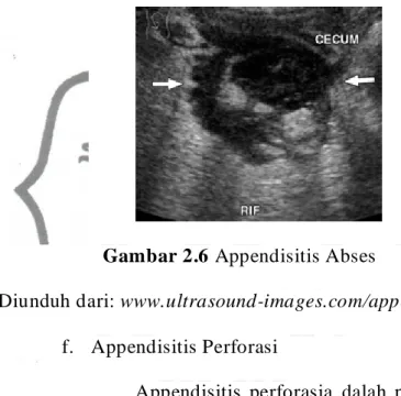 Gambar 2.6 Appendisitis Abses 