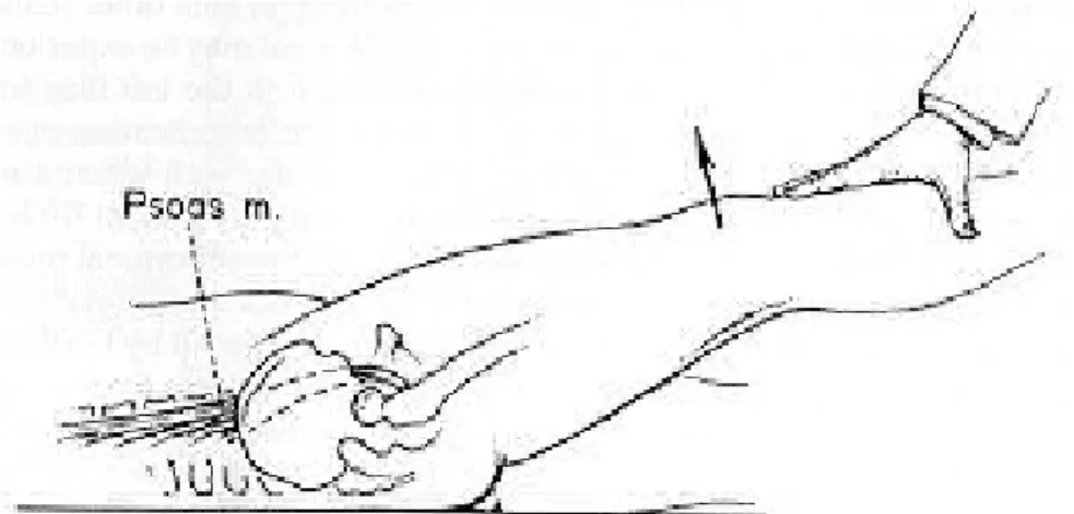 Gambar 2.1 Pemeriksaan Rovsing’s Sign  Sumber: Aryani, 2009, Appendicitis Acute 