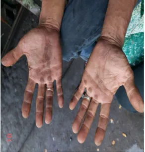 Gambar 1. Tangan responden yang  mengalami dermatitis kontak iritan. 