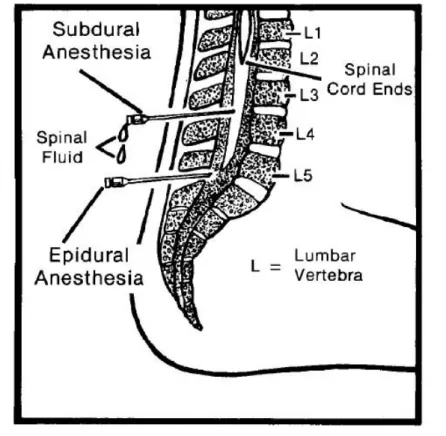 Gambar 2.2 Anestesi Spinal Sumber : Fundamental of Nursing 2.4 Persiapan Pasien