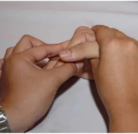 Gambar 7. Akhir dari ROM fleksi MCP joint kedua, tangan kanan fisioterapis menstabilisasi  metacarpal kedua dan menjaga wrist pada posisi netral