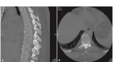Gambar 5.9. (A) Potongan Sagital dan (B) Potongan axial CT scan  dari tulang belakang di bagian thoraks yang menunjukkan adanya penebalan 