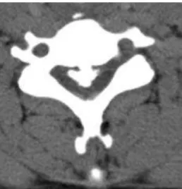 Gambar 5.11. Tanda single-layer memiliki karakter massa besar dengan sentral  irregular hiperdens dengan aspek dorsal dari corpus vertebrae cervical