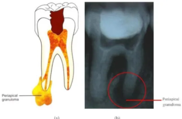 Gambar 0.1 (a) Gambaran Periapikal Granuloma [5] ; (b) Radiografi periapikal granuloma  2.3       Radiografi Periapikal 