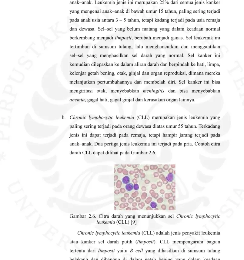 Gambar  2.6.  Citra  darah  yang  menunjukkan  sel  Chronic  lymphocytic  leukemia (CLL) [9] 