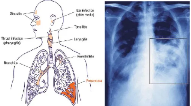 Gambar 1 Kondisi paru-paru penderita pneumonia  (sumber  gambar  pertama:  http://www.nps.org.au,  sumber gambar kedua : http://3.bp.blogspot.com/)  Kondisi  balita  Indonesia  yang  semakin  banyak  terjangkit  pneumonia  membuat  pemerintah  menjadikan  