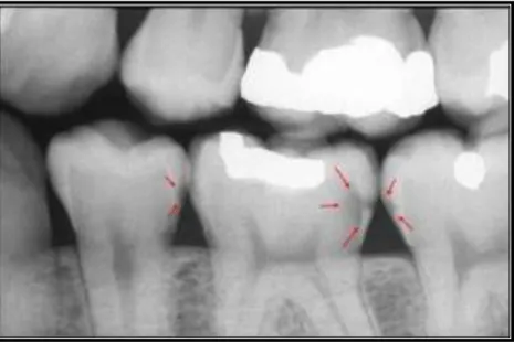Gambar 2.2 Radiografi bitewing yang menggambarkan adanya karies (lihat panah  merah)  terlihat  lebih  radiolusen  daripada  email  dan  dentin  (Kidd dan Bechal 1991)