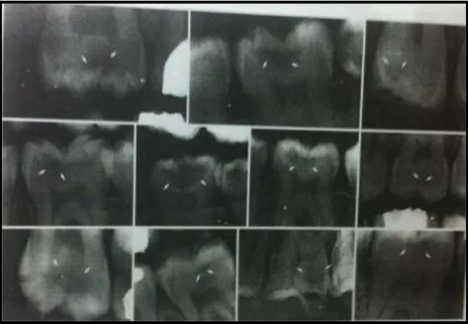 Gambar  2.3  Radiografi  bitewing  yang  menggambarkan  adanya  karies  oklusal  (lihat panah putih) terlihat radiolusen  yang berbeda dalam dentin di  permukaan oklusal (Kidd dan Bechal 1991)
