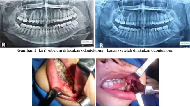 Gambar 1 (kiri) sebelum dilakukan odontektomi, (kanan) setelah dilakukan odontektomi   