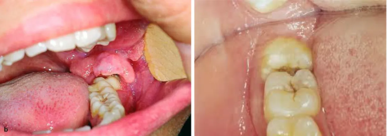 Gambar 3 Perikoronitis dan karies gigi, salah satu indikasi pencabutan gigi impaksi
