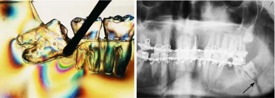 Gambar 11 Fotoelastik menunjukkan tekanan yang berlebihan saat pengungkitan gigi molar 3 impaksi  (kiri), Fraktur angulus mandibula, akibat tekanan berlebihan pada saat dilakukan luksasi 