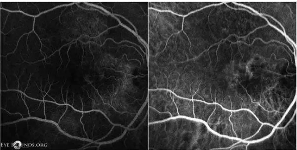 Gambar  6.  OD  FFA  (kiri)  dan  indocyanine  green  angiography  (kanan)  menunjukkan lesi fluorescein punctate pada bagian temporal ke saraf optik  di makula nasalis, sebagian besar merupakan lesi polifoid ( Ryan S, 2006 ) 