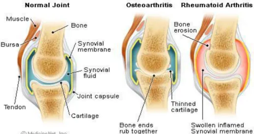 Gambar 1. A Kiri : sendi lutut normal.B. Kanan : sendi lutut yang mengalami  osteoarthritis (Helmi, 2012) 