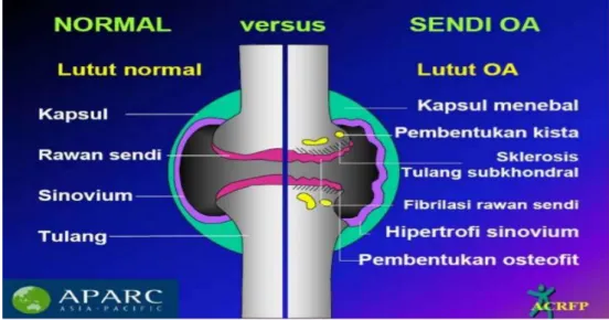 Gambar 2. 1. Sendi normal dan Sendi terkena Osteoarthritis 