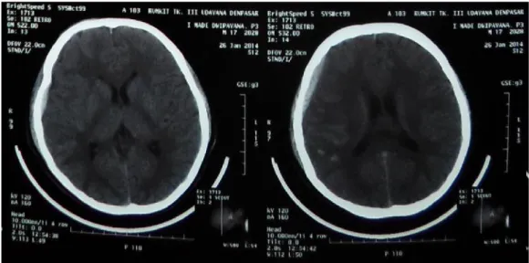 Gambar 1 CT Scan kepala hari pertama setelah trauma
