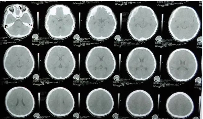 Gambar 2 CT scan kepala control, perawatan hari ke 4