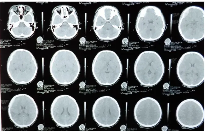 Gambar 3 CT scan kepala control hari perawatan ke 5 pasca kejang