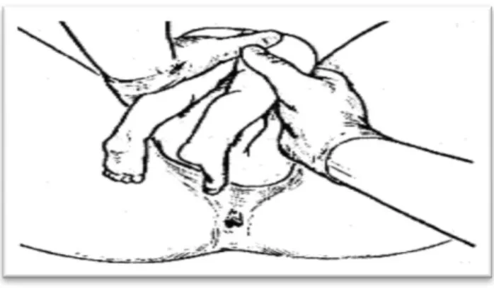 Gambar 2.2 Pegangan panggul anak pada persalinan spontan  Bracht. 
