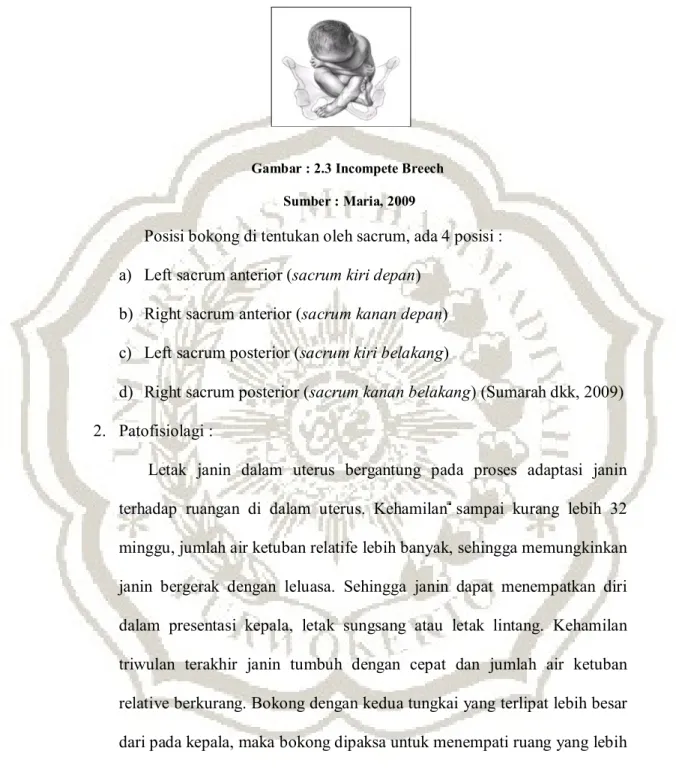 Gambar : 2.3 Incompete Breech   Sumber : Maria, 2009