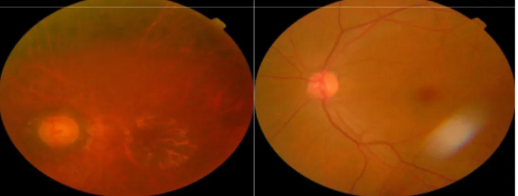 Gambar  2.6:  Gambaran  retina  yang  membingungkan.  Gambar  pertama  berisi  Patch  dengan  intensitas  warna  yang  sama  dengan  diskus  optik  dan  dapat  menimbulkan  kekeliruan  dengan  eksudatnya