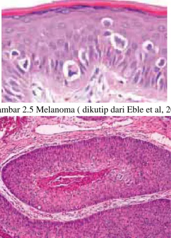 Gambar 2.5 Melanoma ( dikutip dari Eble et al, 2004) 
