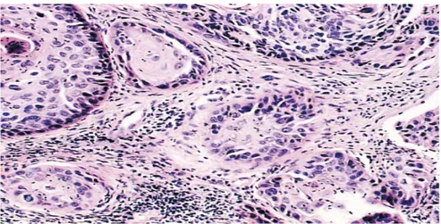 Gambar 2.3   Keratinizing invasif karsinoma sel skuamosa  (histologi).Kelompok  sel-sel kanker (-&gt;) menyerang stroma  di mana sel-sel inflamasi yang terlihat (Cervical Cytology,  Leonardo da Vinci, 2013)