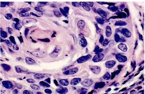 Gambar 2.4  Karsinoma invasif diferensiasi sel skuamosa  (histologi).Pandangan daya tinggi dari sekelompok sel-sel  kanker.Catatan keratinisasi sel tumor di pusat (-&gt;) (Cervical  Cytology, Leonardo da Vinci, 2013)