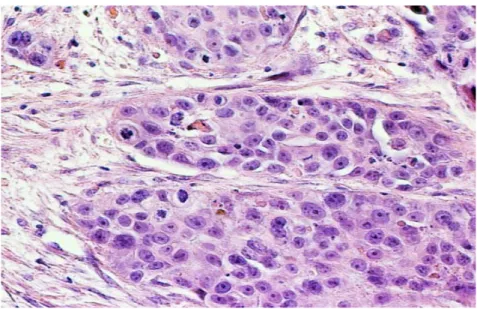 Gambar 2.6   Nonkeratinizing karsinoma sel skuamosa invasif (histologi). 