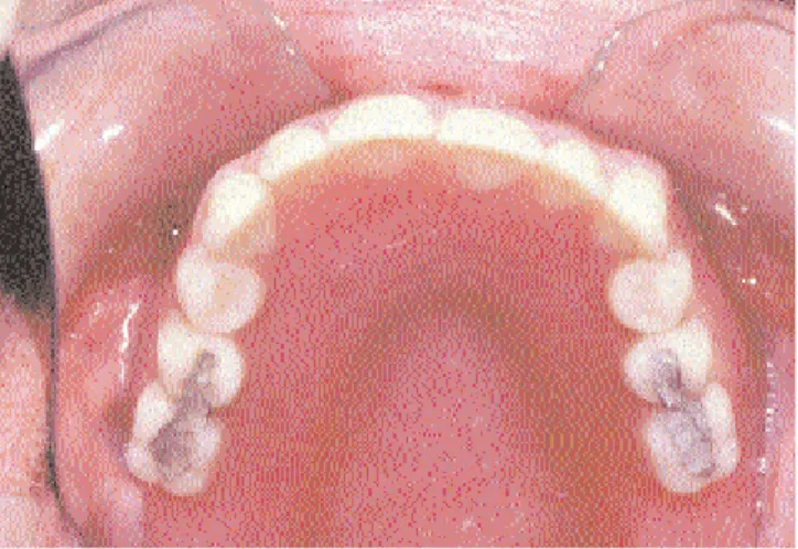 Gambar 4.1 Gigi tiruan lengkap rahang atas dengan amalgam pada permukaan oklusal gigi  artifisial posterior 
