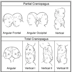 Gambar 2.6 Tipe-tipe kraniopagus 
