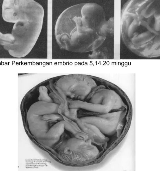 Gambar bayi kembar dengan amnion masing-masing 