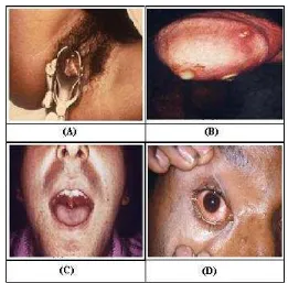 Gambar 1. Contoh infeksi gonokokal non komplikasi (A) infeksi gonokokal serviks (B) infeksi gonokokal uretra (C) infeksi gonokokal faring (D) infeksi gonokokal konjungtivis (Centers for Disease Control and Prevention, 2005)
