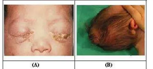 Gambar 2. Contoh infeksi diseminasi gonokokal (A) infeksi gonokokal lesi pada jari (B) 