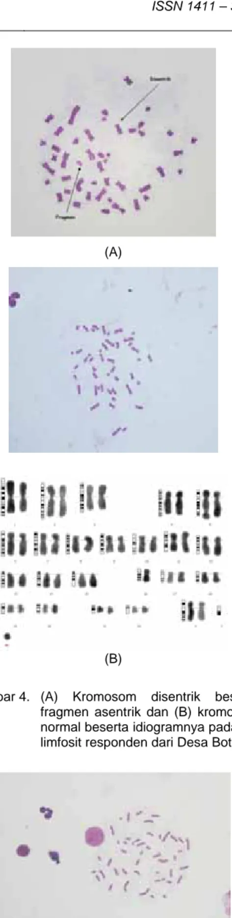 Gambar 4.   (A)  Kromosom  disentrik  beserta  fragmen asentrik dan (B) kromosom  normal beserta idiogramnya pada sel  limfosit responden dari Desa Boteng