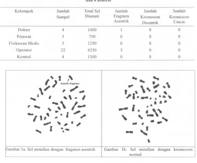 Tabel 2. Hasil pemeriksaan aberasi kromosom tak stabil pada 34 pekerja radiasi rumah sakit dan 4 kontrol Kelompok Dokter Perawat Fisikawan Medis Operator Kontrol