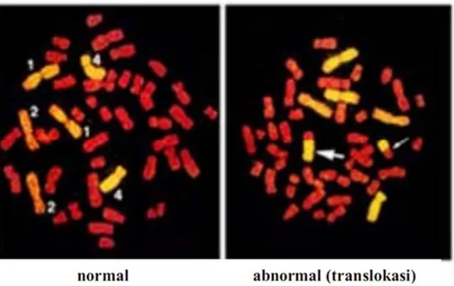 Gambar 6. Hasil Analisa In Situ Hybridization pada Translokasi Kromosom