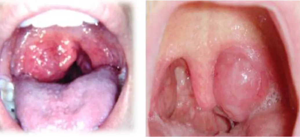 Gambar 2.7 NHL pada tonsil  2 